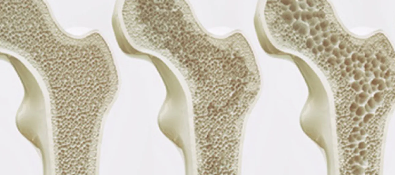 Mieux comprendre l’ostéoporose