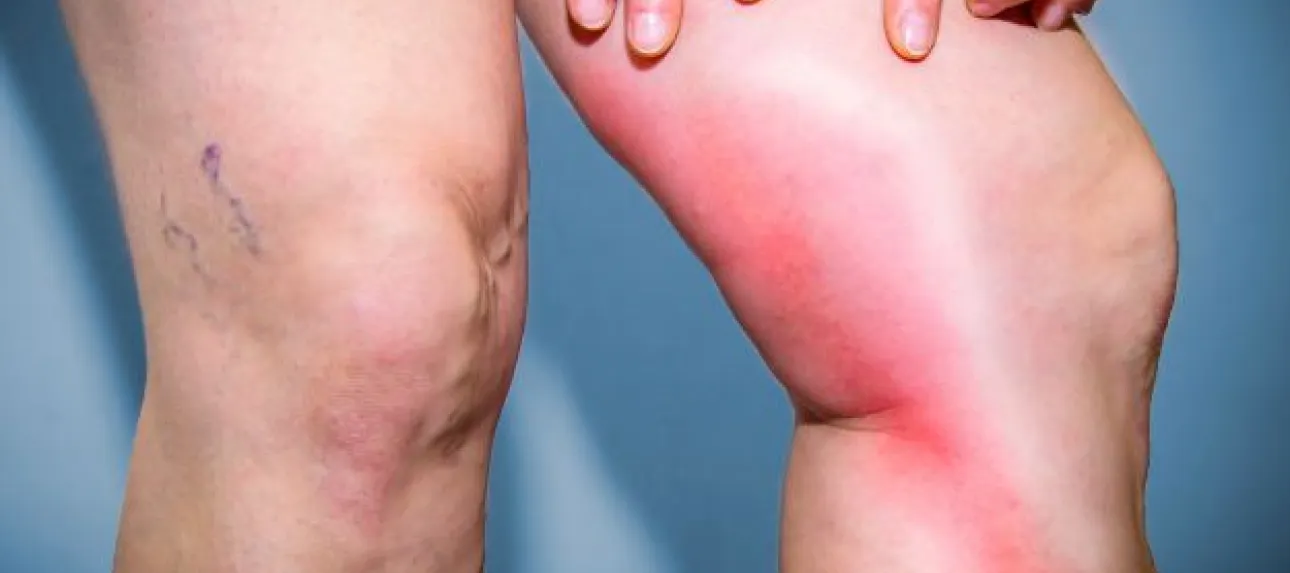phlebite aux jambes