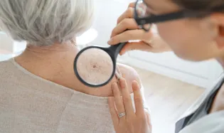 Maladie de la peau senior