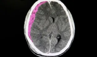 hématome sous dural