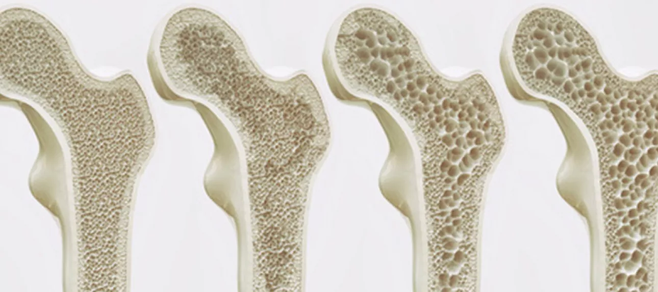 Mieux comprendre l’ostéoporose